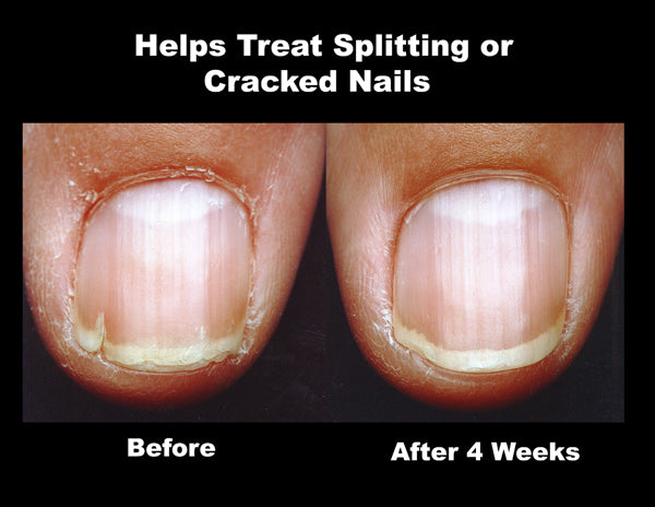ProStrong ProAdvanced Fluoride Nail Strengthener Duo